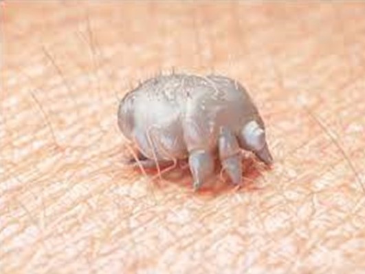 scabies